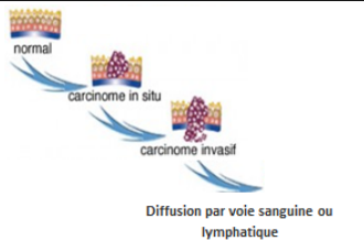 cancer du foie douleur au ventre